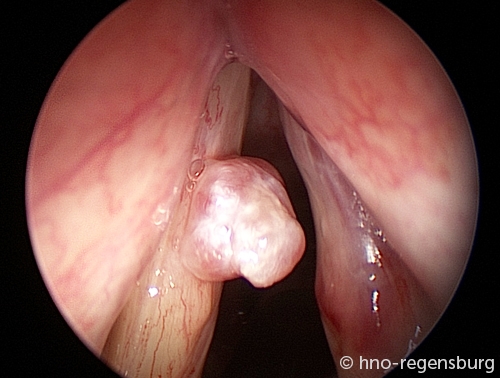 stimmbandpolyp
