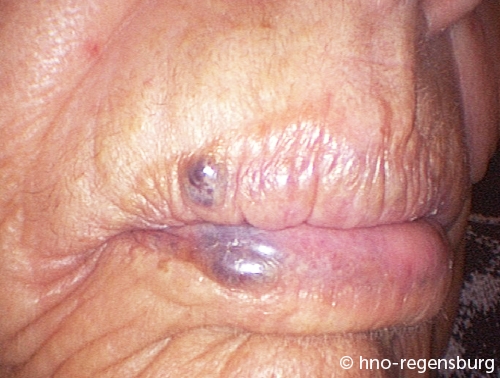 lippen haemangiom