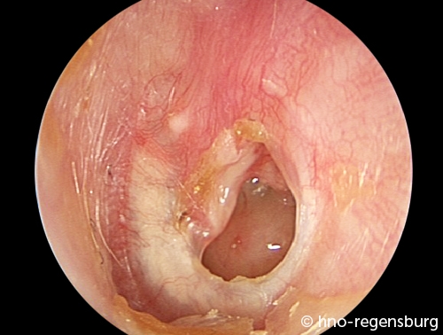 tromelfellperforation