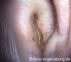 Gehörgangsentzündung links