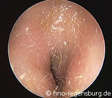 Gehörgangsentzündung rechts