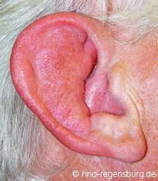 Ohrmuschelentzündung rechts