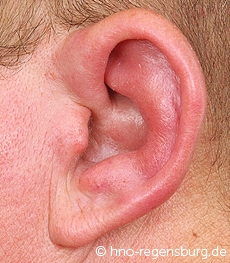 Ohrmuschelentzündung links