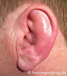 Ohrmuschelentzündung links