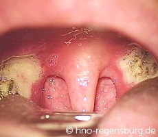 Ca tonsillen Tonsillitis