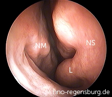 Schiefe Nasenscheidewand rechts