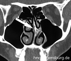 Computertomographie der Nasennebenhöhlen