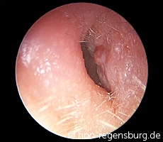 Diese Art der Gehörgangsentzündung entsteht meistens bei Patienten mit eine...